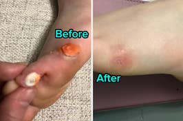 reviewer with two corns on foot then reviewer's foot healed