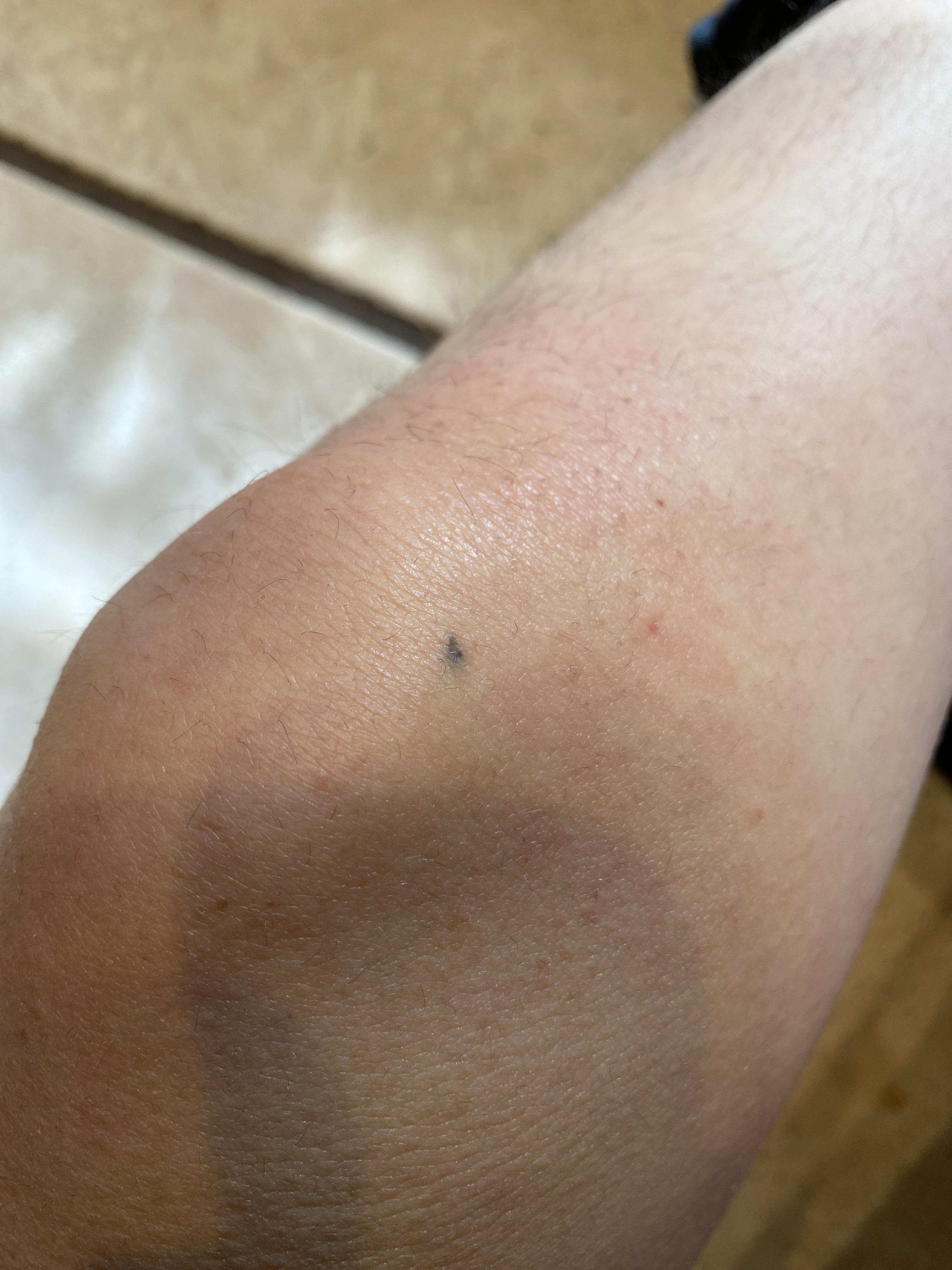 Close-up of a person&#x27;s arm showing a bruise with a small dark mark, possibly a freckle or mole