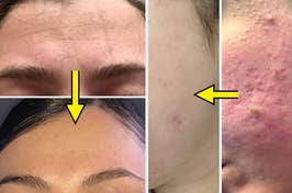 Before and after comparison of a skincare treatment on a person's forehead and cheek
