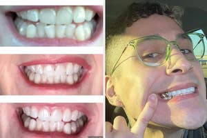 Person showing before/after results of teeth-whitening, smiling in the final frame