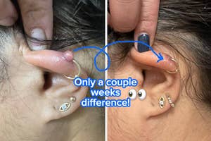 Before and after photos of an ear healing from a piercing bump with captions highlighting the time difference