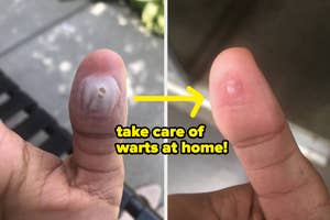 Before and after comparison of a wart treatment on a finger