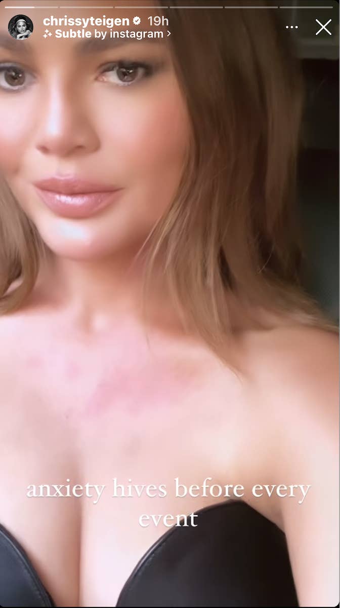 Chrissy Teigen&#x27;s selfie showing her face and neck with visible hives, captioned &quot;anxiety hives before every event.&quot;
