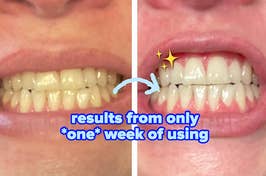 Before and after comparison of teeth, showing improvement in whiteness from a product after one week of use