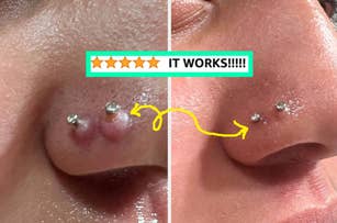 reviewers nose piercings with keloids on them and then the keloids gone after using bump treatment