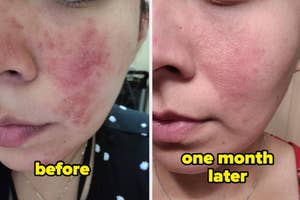 Before and after facial skincare results, with improved skin texture on the right