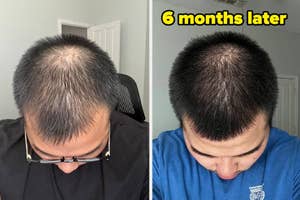 Before and after comparison of a person's hair growth over 6 months