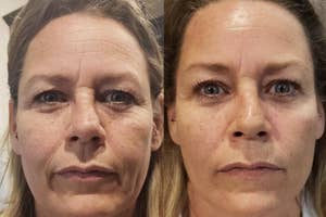 Before and after comparison of a reviewer's facial skincare treatment results