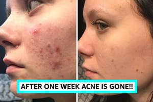 Before-and-after side profiles of a person's face showing acne treatment results "after one week acne is gone"