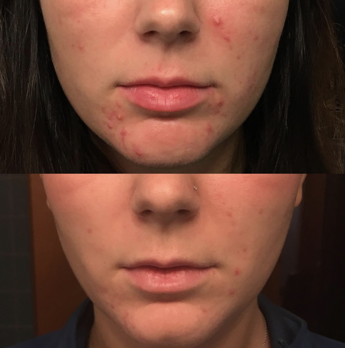 Before and after comparison of a person&#x27;s skin treatment with visible improvement in acne
