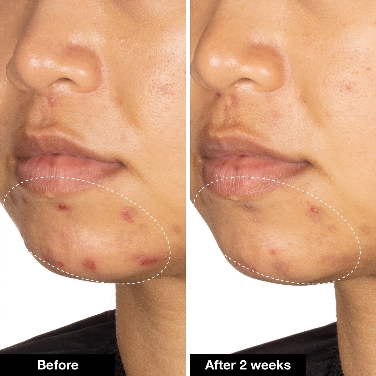 Close-up of a person&#x27;s lower face showing skin improvement from acne treatment before and after two weeks