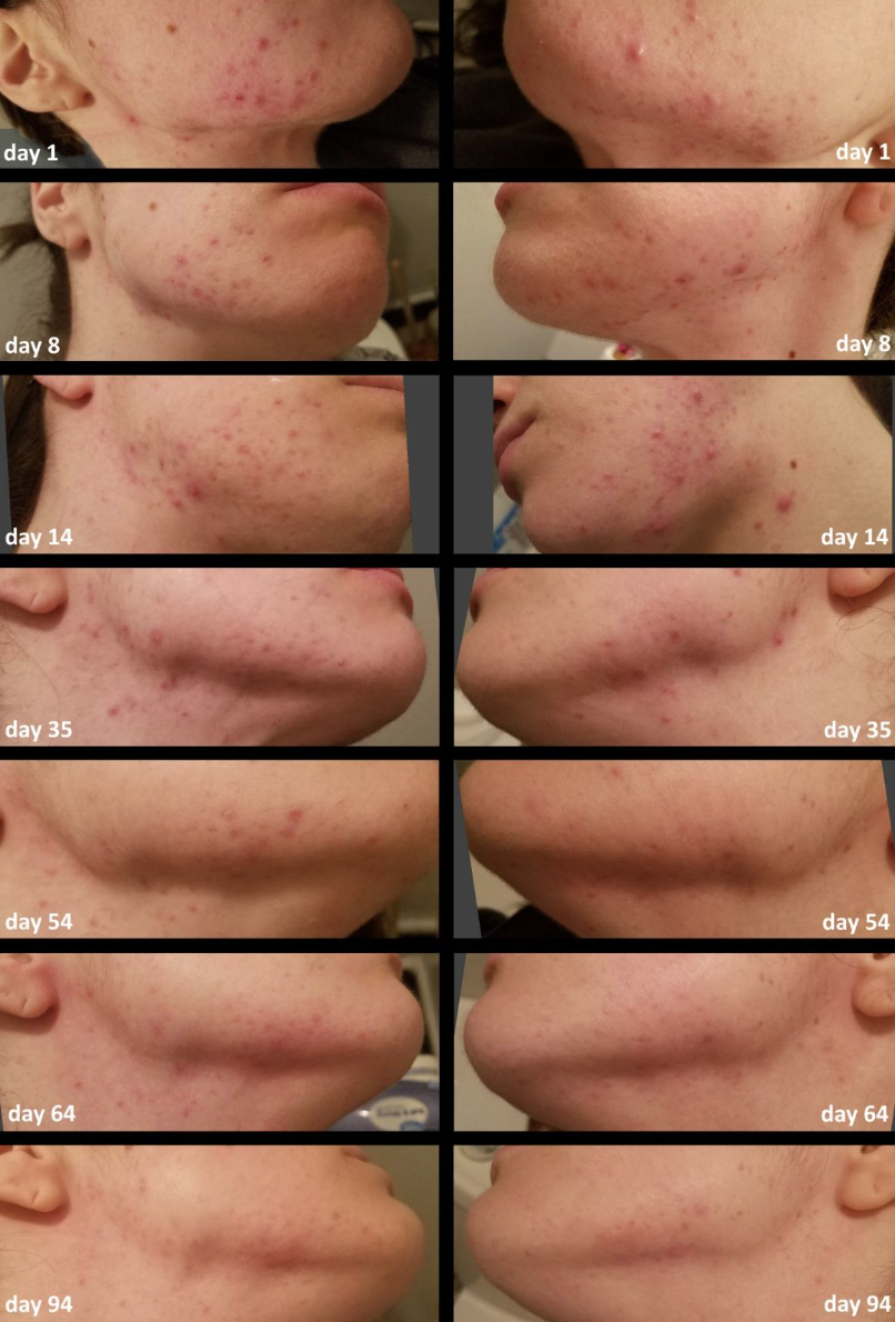 A collage of progress photos over 94 days showing improvement of skin condition on a person&#x27;s cheek and jawline