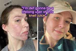 Before and after photos of a reviewer's skin improvement "I'm def gonna be a lifelong user of this snail juice"