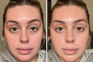 Woman before and after using facial skincare product, showing clear skin improvement