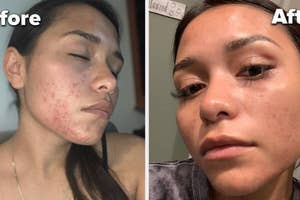 Woman showing before and after results of skincare treatment