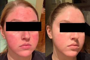 Person showing before and after skincare treatment results, with improved skin texture