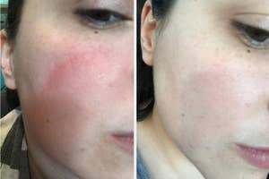 Before and after comparison of skin care treatment on a person's cheek