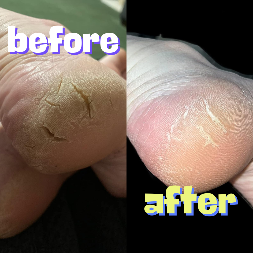 Close-up of a person&#x27;s heel before and after treatment, showing cracked skin and then healed skin