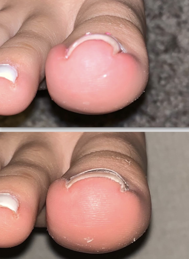 close-up of reviewer&#x27;s toenail before and after using product to relax its curl