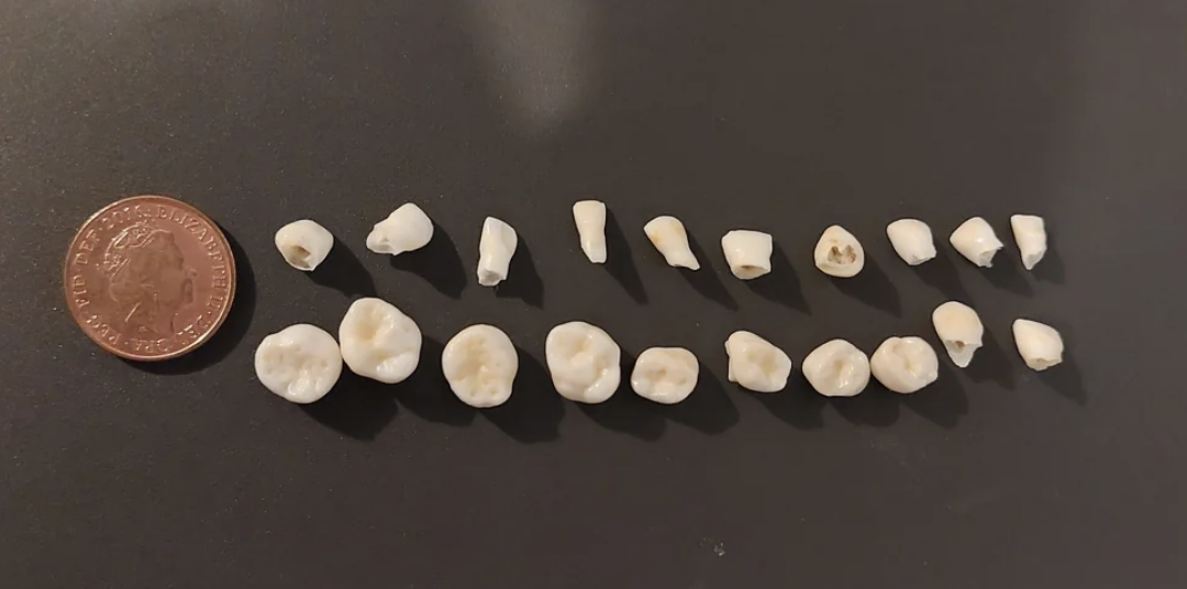 Several extracted human teeth of varying sizes are displayed in a row next to a penny for scale