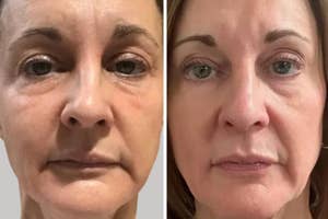 Before and after images of a woman's face, likely illustrating results from a skincare product or cosmetic procedure