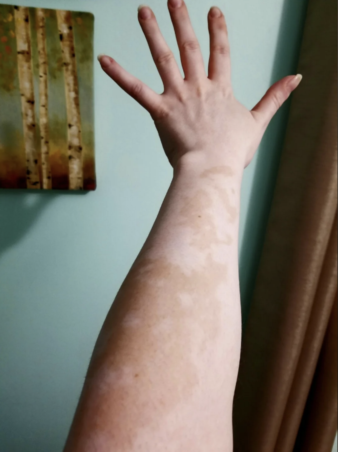Person&#x27;s arm extended upwards with visible vitiligo patches