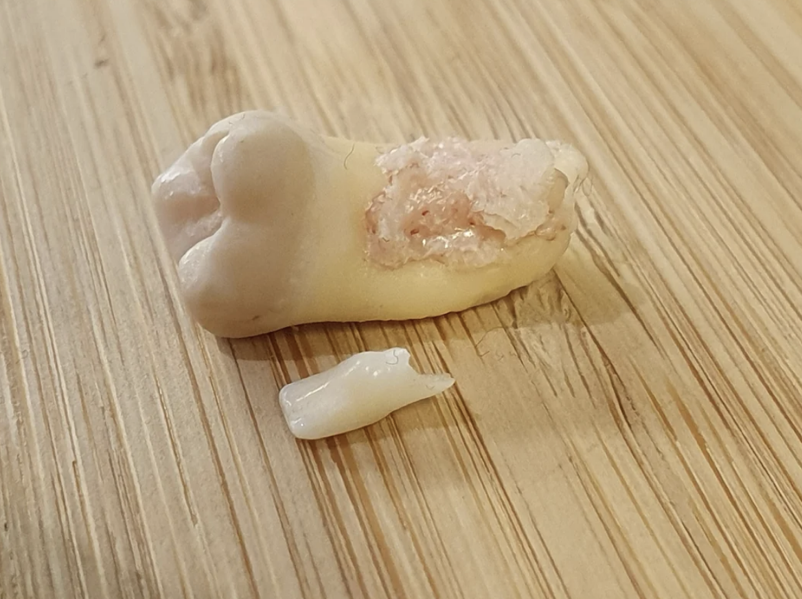 a baby tooth next to a wisdom tooth