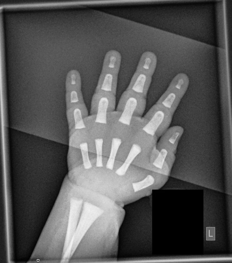 X-ray image of a human left hand showing bones
