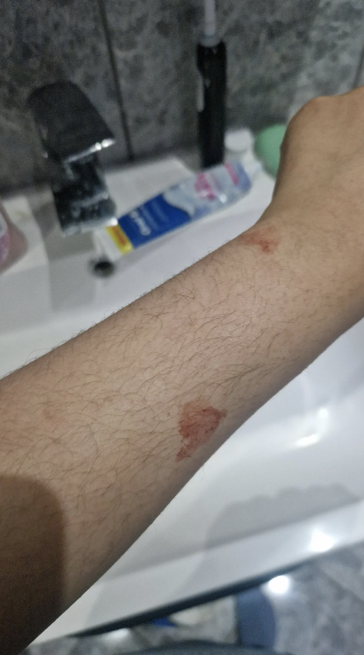 Person&#x27;s arm with healing abrasions, near a bathroom sink with toiletries in the background