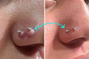 reviewers nose with keloids then bumps gone after using solution
