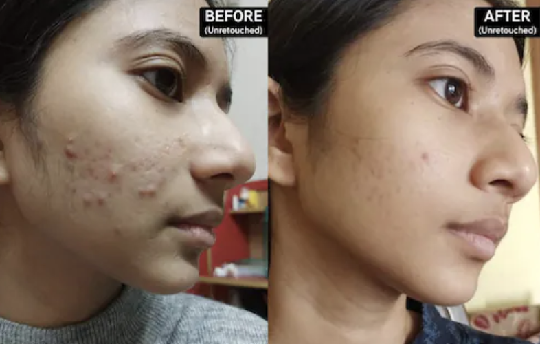 Side-by-side examination  of a person's facial tegument  earlier  and aft  treatment, showing wide   improvement