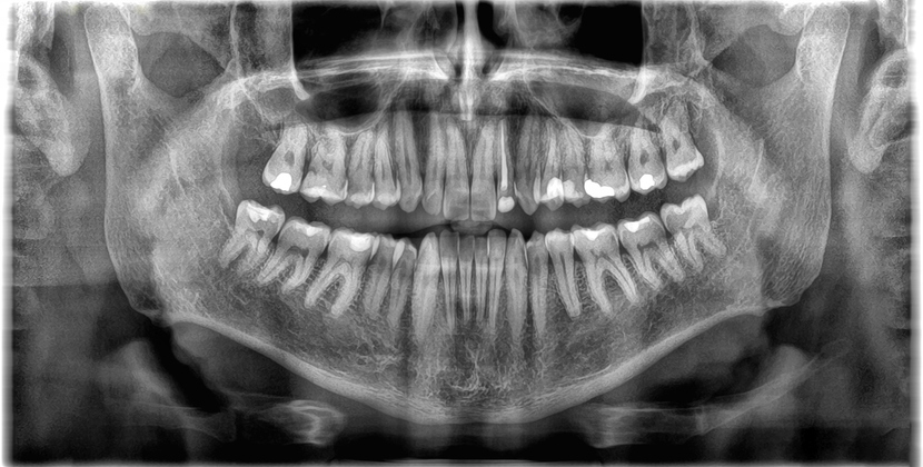 Dental panoramic radiograph showing upper and lower teeth and jawbone structure