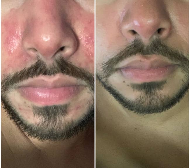 Close-up before and after comparison of a reviewer's nose and mouth showing skin improvement