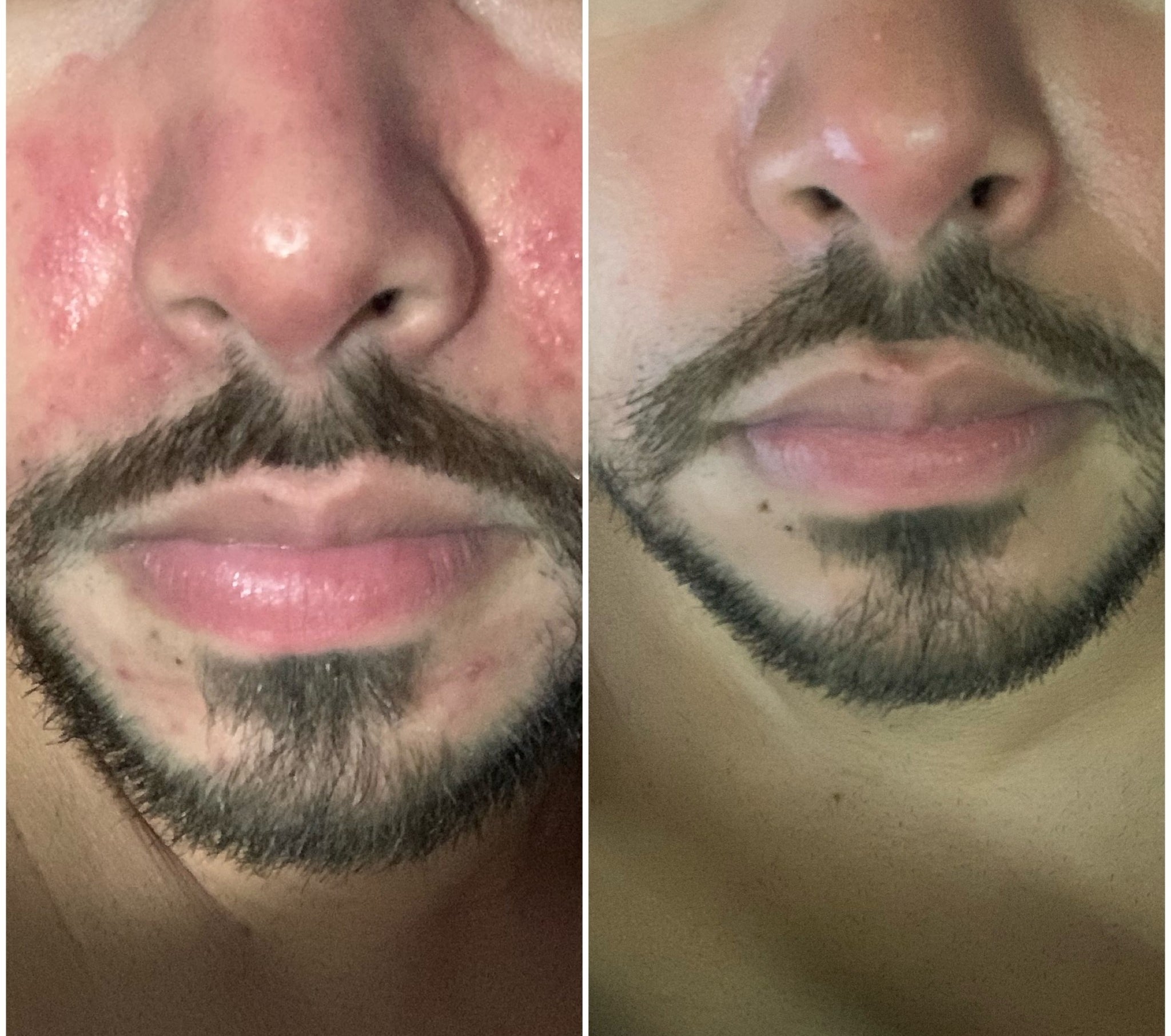 Close-up before and after comparison of a reviewer&#x27;s nose and mouth showing skin improvement