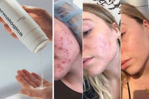 Four-part collage showing a bottle with skincare product dispensing, and three different individuals with acne before and after treatment