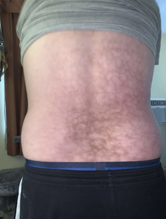 Skin with a pattern of darker patches, possibly a skin condition or birthmark, on a person&#x27;s back