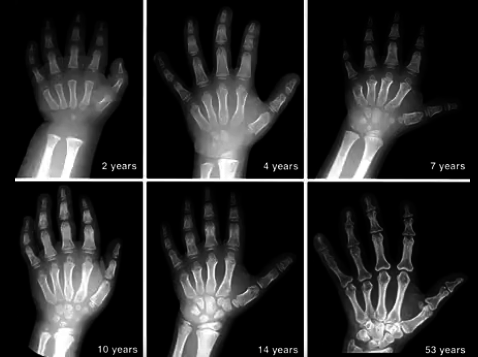 X-ray images of a human hand at different ages showing bone development stages