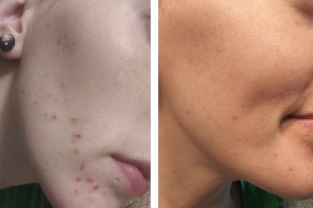 If There Were An Acne Solutions Hall Of Fame, You Would Definitely Find These 21 Products There