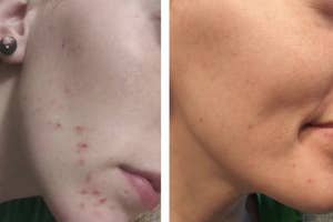 Close-up before and after comparison of a person's lower face showing improvement in skin clarity after using acne spot treatment