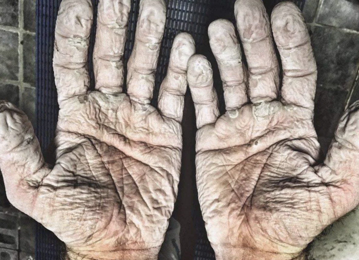 Two hands soaked, showing the effect of prolonged water exposure, palms up