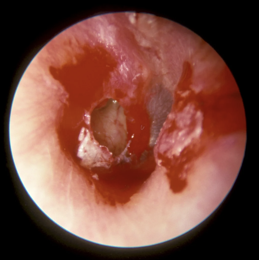 Endoscopic view of a medical condition within an ear