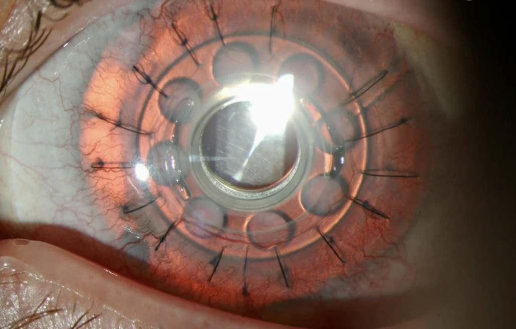 Close-up of a human eye with a medical ring device implanted for a surgical procedure