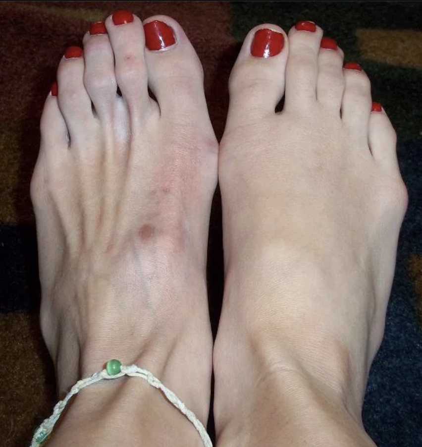comparing an atrophied foot to a normal one