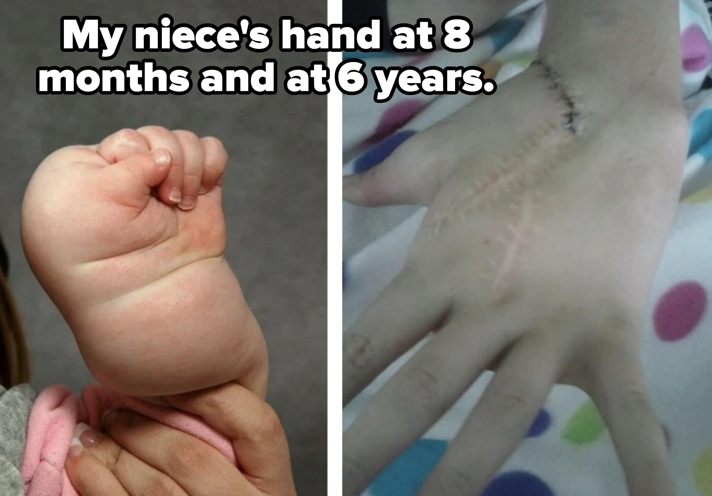 Two images: left shows a baby&#x27;s hand gripping an adult&#x27;s finger; right shows an arm with surgical stitching