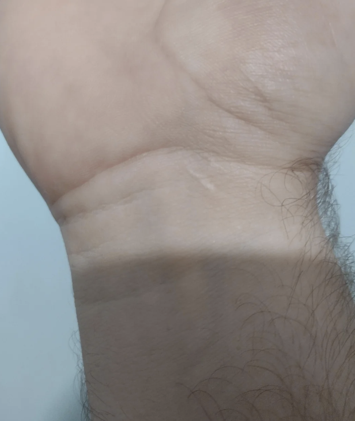 Close-up of a person&#x27;s wrist showing skin folds and a few hairs