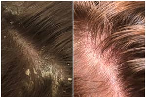 Parted hair showing scalp before and after using dandruff treatment