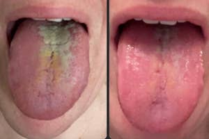 Two side-by-side photos showing a tongue before and after using a tongue scraper