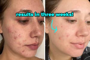 before and after of reviewer with acne and significantly less after