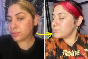 before/after of reviewer's skin after using a vitamin c serum, showing reduced acne and brighter skin