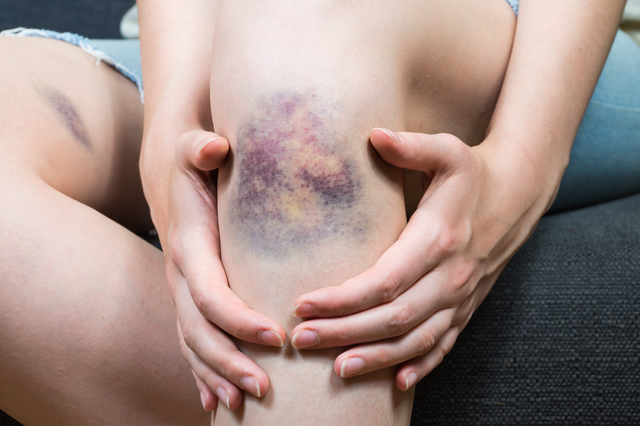 Close-up of a person's knee showing a large bruise, hands gently surrounding the injured area